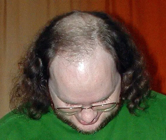 male pattern baldness