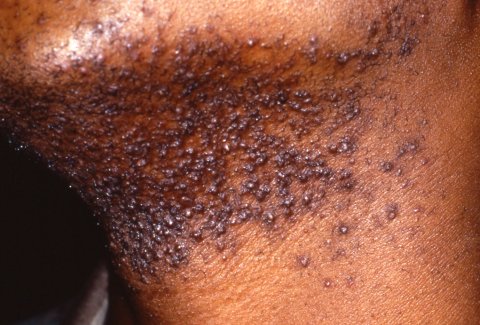 Razor Bumps, Razor Bumps Treatment, Razor Bumps Causes - Cosmetic  Dermatology India