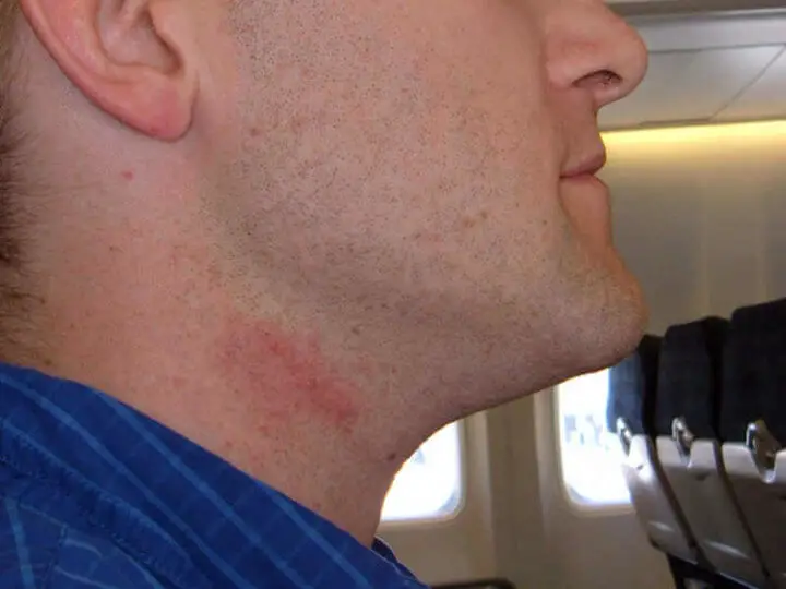 razor burn on neck