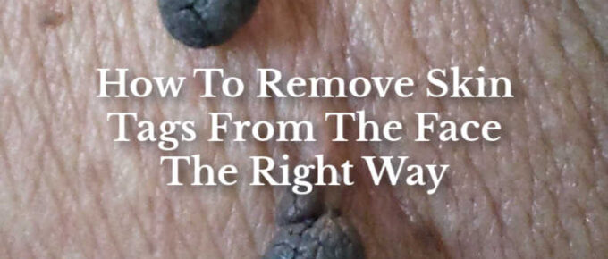 how to remove skin tags from the face the right way