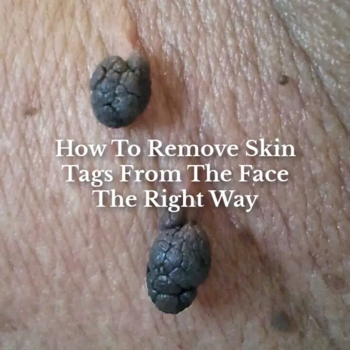 how-to-remove-skin-tags-from-the-face-sharpologist