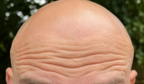 my bald forehead