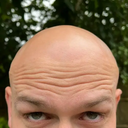 my forehead