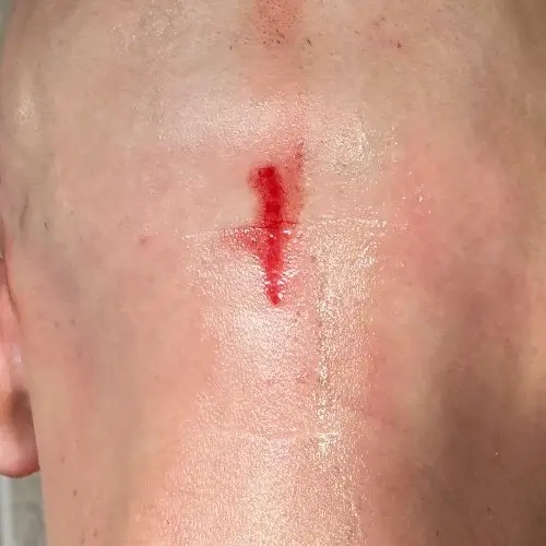 shaving cut on scalp