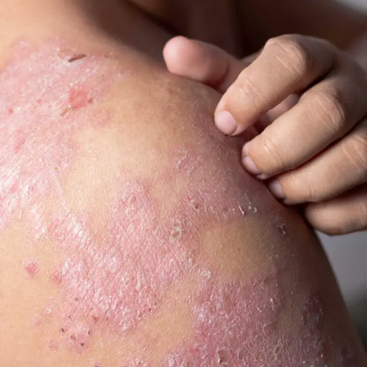 psoriasis