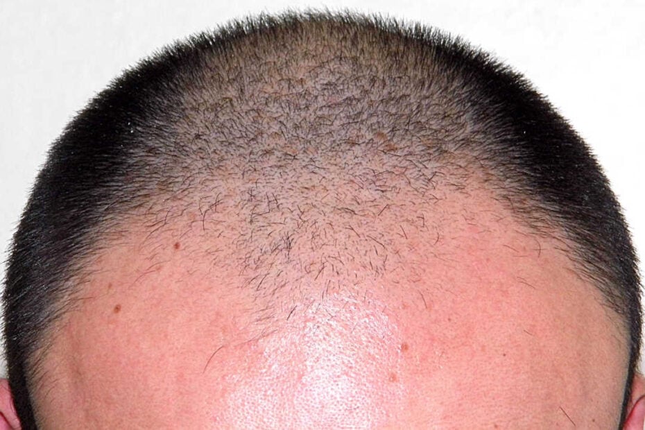 male pattern baldness