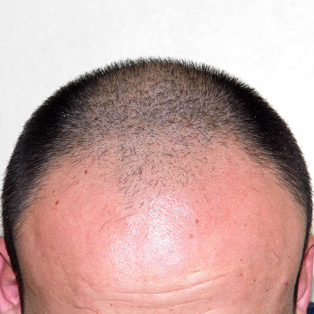 male pattern baldness